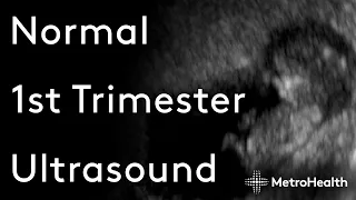 Normal 1st Trimester Ultrasound