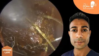 1,239 - Completely Occluding Ear Wax Removed from Both Ears