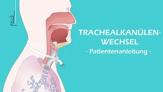 Trachealkanülenwechsel für Patienten | Animation | Fahl Medizintechnik-Vertrieb GmbH