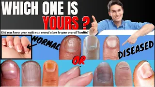 Know! What Your Nails Say About Your Health (2021),9 Nail Signs of Health Problems,Grow Nails Fast