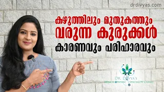 How To Get Rid of Back Acne the Natural Way | കഴുത്തിലും മുതുകത്തും വരുന്ന കുരുക്കൾക് പരിഹാരം