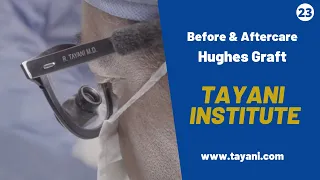 Hughes Graft Diagnosis / Before & After | Tayani Institute