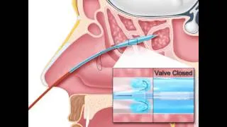 Sphenoid Sinus Balloon Sinuplasty - Medical Animation by Watermark