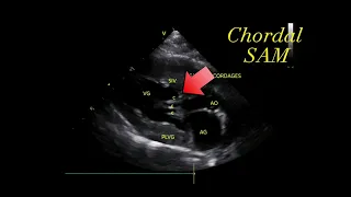 Systolic anterior motion (SAM) of the mitral chordae tendineae (chordal SAM) 