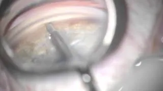 example of too much force during entry of Schlemm's canal, s/p heavy trabeculoplasty