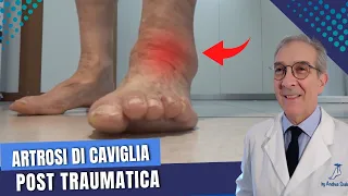 ARTROSI DELLA CAVIGLIA cause, sintomi e cure | Artrosi post traumatica | Dott. Andrea Scala