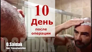 Пересадка Волос На Личном. 10-ый День После Операции.