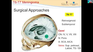 Management of Tentorial & Falcotentorial Meningiomas