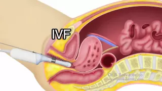 Video 4.1 ADENOMYOSIS