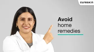 Say no to home remedies   | Cureskin