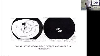 Visual Field Defects - Where is the Lesion?: Dr Henrietta Ho