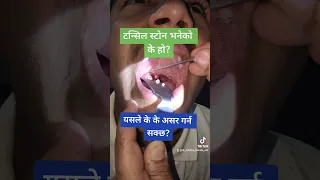 Tonsil stones (Tonsillolith) // Tonsillar debris removal // Dr Krishna Koirala // Pokhara