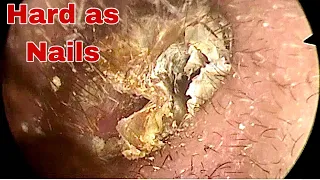 Hard as Nails Earwax Removal | Doctor Anh