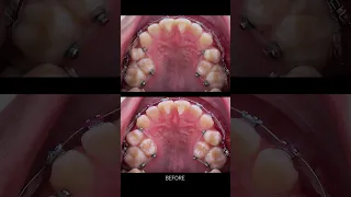 Braces process - crowded teeth