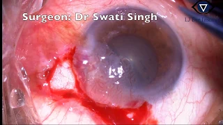 Ocular surface tumor excision by Dr. Swati Singh, oculoplastics surgeon