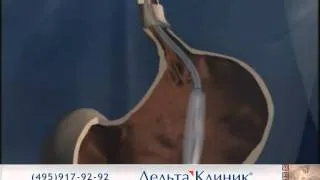 Внутрижелудочный баллон для лечения ожирения!