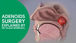 Adenoid Surgery By Dr Rajesh Bhardwaj | #adenoidectomy #sleepdisturbedbreathing #coblation #adenoids