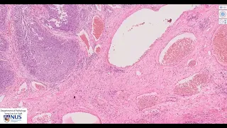 Bladder: Papillary urothelial carcinoma Microscopy  - Talking slide