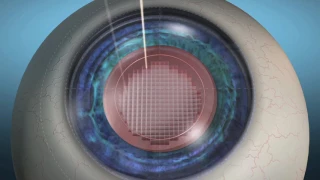 Laser Cataract Femtosecond Animation