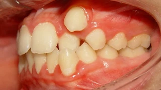 Orthodontic Treatment of Ectopic Upper Canine - No Extraction (Salah 12yrs)