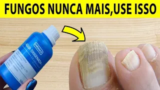 NUNCA MAIS TIVE FUNGOS E MICOSE NAS UNHAS DEPOIS QUE USEI ESSA RECEITA