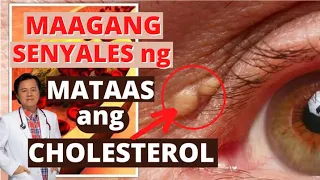 Maagang Senyales ng Mataas ang Cholesterol - Payo ni Doc Willie Ong #1338