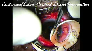 PK(Sclero- Corneal Graft) in Mooren's Ulcer