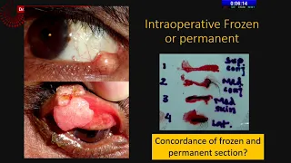 AIOC2020 IC387 T5 Dr Sima Das Eyelid malignancies  what you must know?