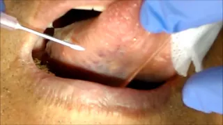 張孟超醫師-刺血療法-舌下靜脈放血法三(肝膽區)tongue bleeding