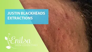 Justin Blackheads Extractions 4th Treatment Part 1