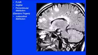 2015 AOCR Radiology Case Review: Neuroradiology - MS