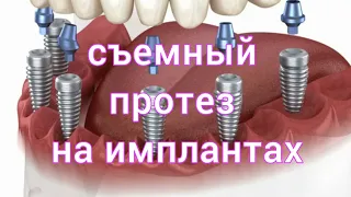 Съемный протез на ИМПЛАНТАХ. Полный СЪЕМНЫЙ ПРОТЕЗ на имплантах.