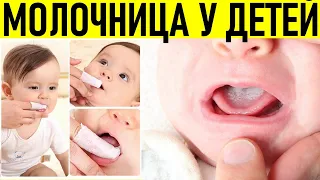 МОЛОЧНИЦА У ДЕТЕЙ | Причины появления, симптомы и лечение