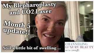 Blepharoplasty 5 Month Update! Scars, Swelling, Hyperpigmentation, Bruising, Eyelid Surgery! CO2 Lsr