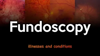 Fundoscopy: Illnesses and Conditions