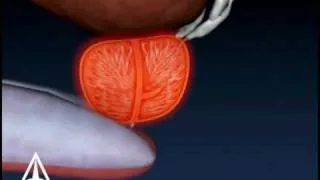 Prostate Biopsy - 3D Medical Animation