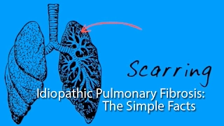 Idiopathic Pulmonary Fibrosis: The Simple Facts