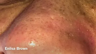 Blackheads Extractions and Acne Treatment on Daryl