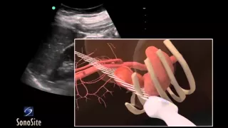 How To: Left Kidney Ultrasound 3D Video
