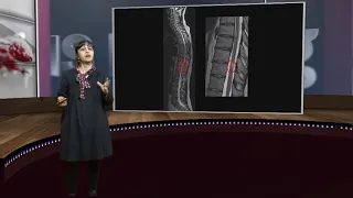 Schmerzen bei Multipler Sklerose: es gibt viele Behandlungsmöglichkeiten