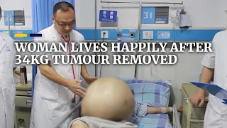 Chinese woman lives happily 4 years after 34kg tumour removed