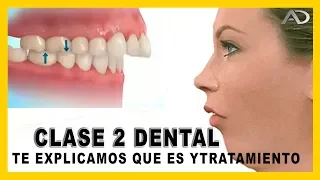 👉Maloclusion dental - 𝙈𝙤𝙧𝙙𝙞𝙙𝙖 𝘾𝙡𝙖𝙨𝙚 𝙄𝙄  dental en Ortodoncia - que es y como corregirla