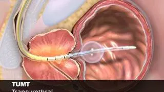 Thermaspec - Microwave Thermotherapy Treatment for BPH and Prostatitis