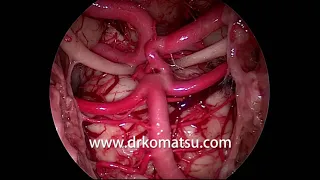 #A16 Retroclival area ; Anatomy for Endoscopic Endonasal Skull Base Surgery