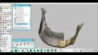 Patient-specific mandible reconstruction implant by Geomagic freeform and haptic device