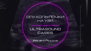 ОПУХОЛЬ ПОЧКИ на УЗИ 🎞️ Ультразвуковая диагностика ⚠️ Кidney cancer 🔍 ULTRASOUND CASES