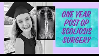 MY ONE YEAR POST OP SCOLIOSIS SURGERY RECAP VIDEO