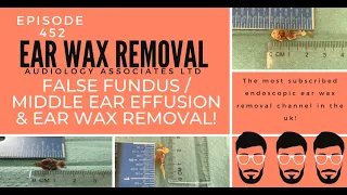 FALSE FUNDUS/MIDDLE EAR EFFUSION & EAR WAX REMOVAL - EP452