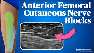 Anterior Femoral Cutaneous Nerve Block (The Cuties!)