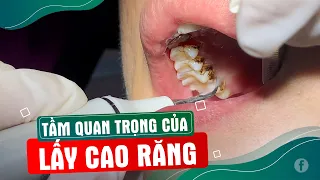 Lấy Cao Răng Đen -  Cao Răng Đen Là Gì? Lấy Vôi Răng.